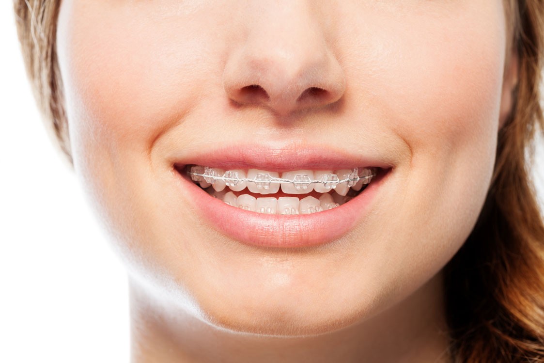 Appareil dentaire orthodontique : indication et entretien