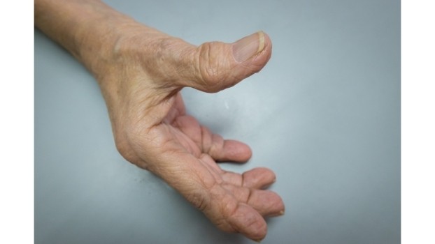 Rhizarthrose : Symptômes, causes et traitements de l'arthrose du pouce