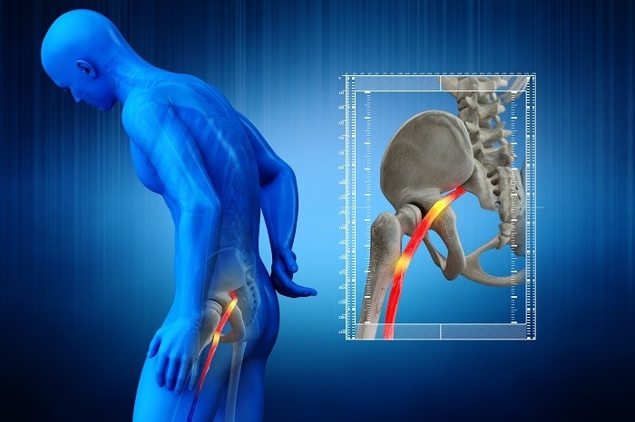 Sciatique : Les astuces de l'ostéopathe pour soulager la douleur