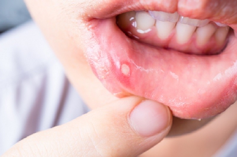 Comment soigner un aphte dans la bouche ? - Conseils bucco-dentaire