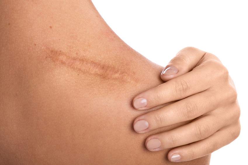 Comment faire pour bien cicatriser et éviter les marques ? - Conseils santé