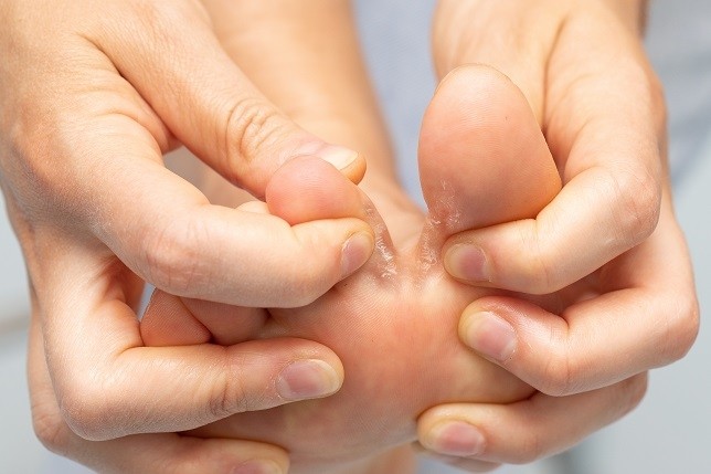 Pied d'athlète : comment traiter une mycose des pieds ? Pharma GDD
