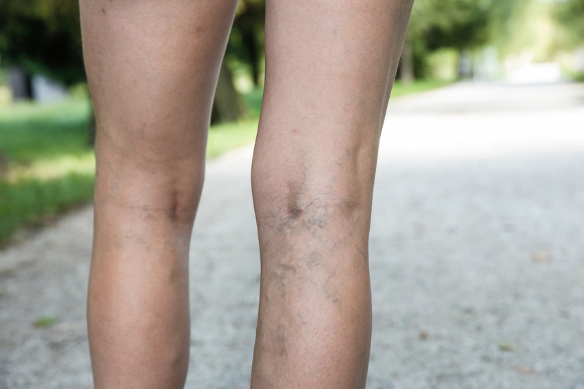varicoza picioarelor picioarelor de pinioane a remediilor populare varicoza picior sinyak