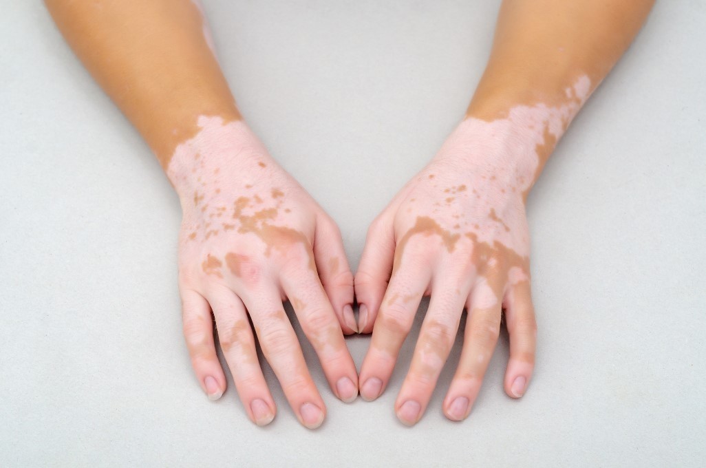Vitiligo : causes, symptômes et traitements – Conseil Santé