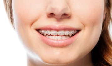 Appareil dentaire orthodontique : pour qui et comment l’entretenir ?