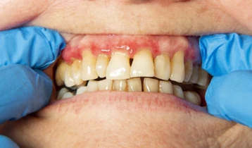 Parodontite : causes, symptômes et traitements