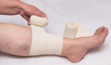 Comment soigner un ulcère de jambe ?
