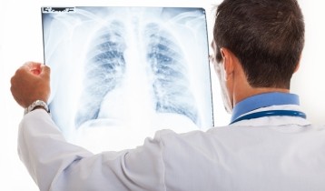 Qu'est-ce que la bronchopneumopathie chronique obstructive (BPCO) ?