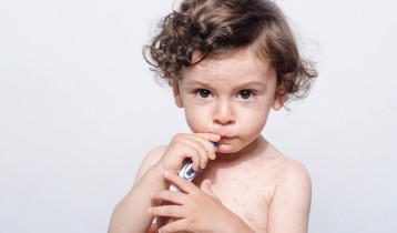 Rougeole : symptômes, prévention et traitement