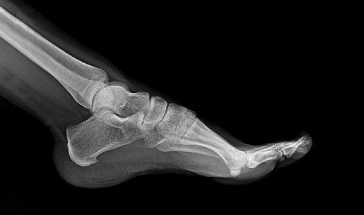 Epine calcanéenne : symptômes, causes et traitements