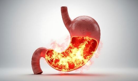Brûlures d'estomac et reflux gastro-œsophagien : causes et solutions