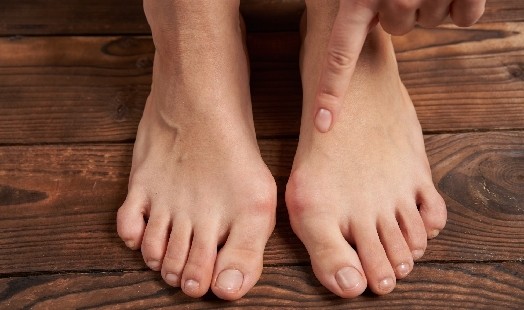 Comprendre et traiter l'hallux valgus : de la déformation aux solutions correctrices