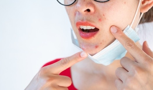 Maskné : comment adapter sa routine beauté au port du masque ?