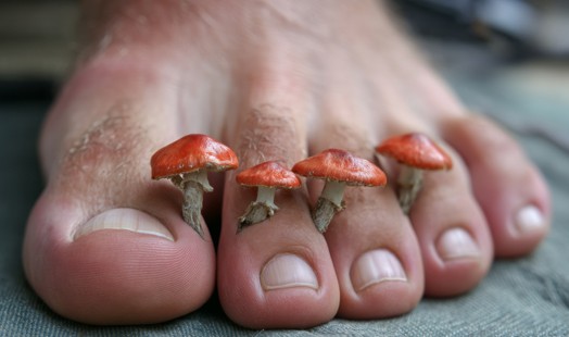 Mycoses des pieds et pieds d'athlète : comprendre, traiter et prévenir