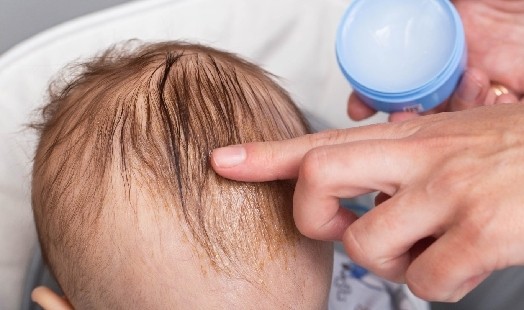 Comment débarrasser bébé des croûtes de lait ?