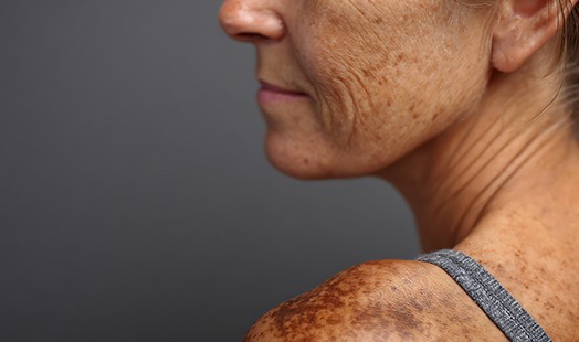 Taches brunes : comment les prévenir et les atténuer