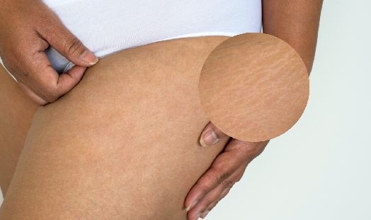 Comment prévenir et réduire l'apparition des marques de vergetures ?