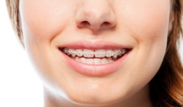 Conseils pour le port des gouttières orthodontiques