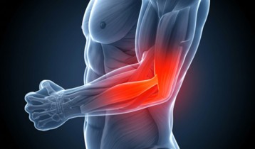Comprendre et traiter l'épicondylite ou tennis elbow