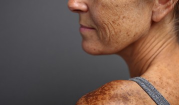 Taches brunes : comment les prévenir et les atténuer