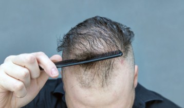 Minoxidil 5 % spray Bailleul - Chute de cheveux - Traitement Alopécie