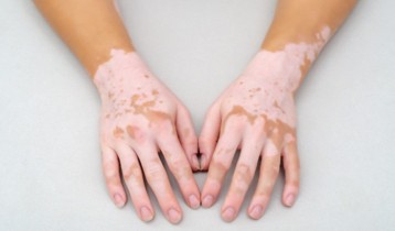 Vitiligo : causes, symptômes et traitements – Conseil Santé