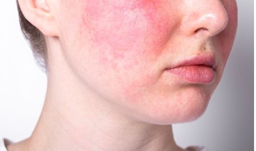 Dermocorticoïdes et syndrome de la peau rouge : quelle conduite tenir ?