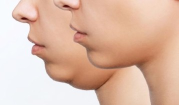 Qu'est-ce que le Mewing, cette technique pour sculpter la mâchoire ?