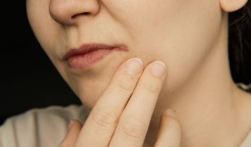 Comment soigner la perlèche et la reconnaître ?